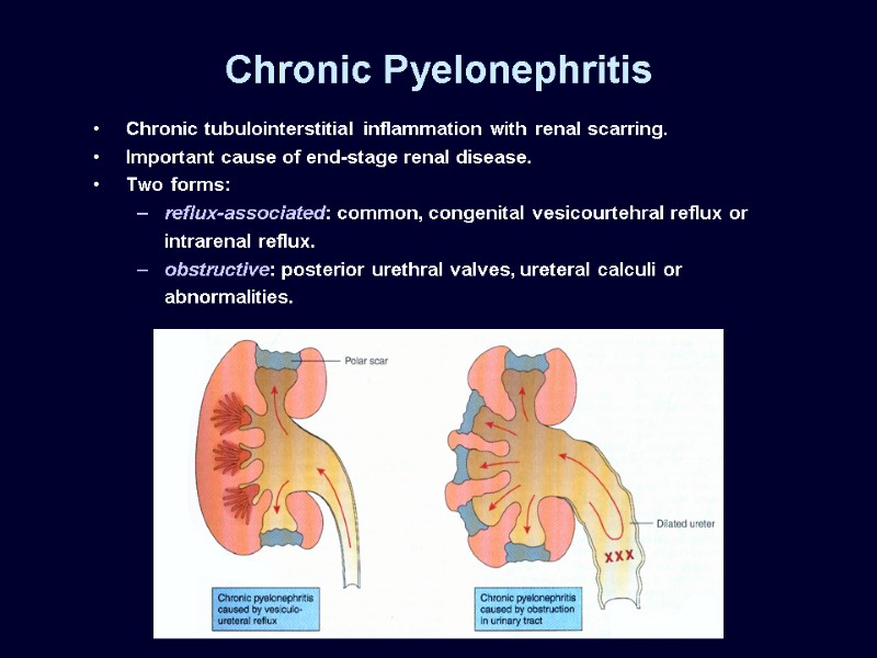 Chronic Pyelonephritis Chronic tubulointerstitial inflammation with renal scarring.  Important cause of end-stage renal